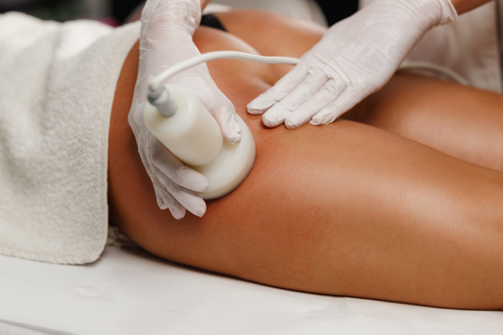 radiofrequency for cellulite Chicago
