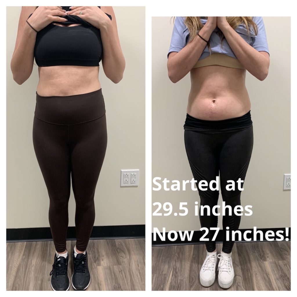 weight loss Chicago body contouring before and after