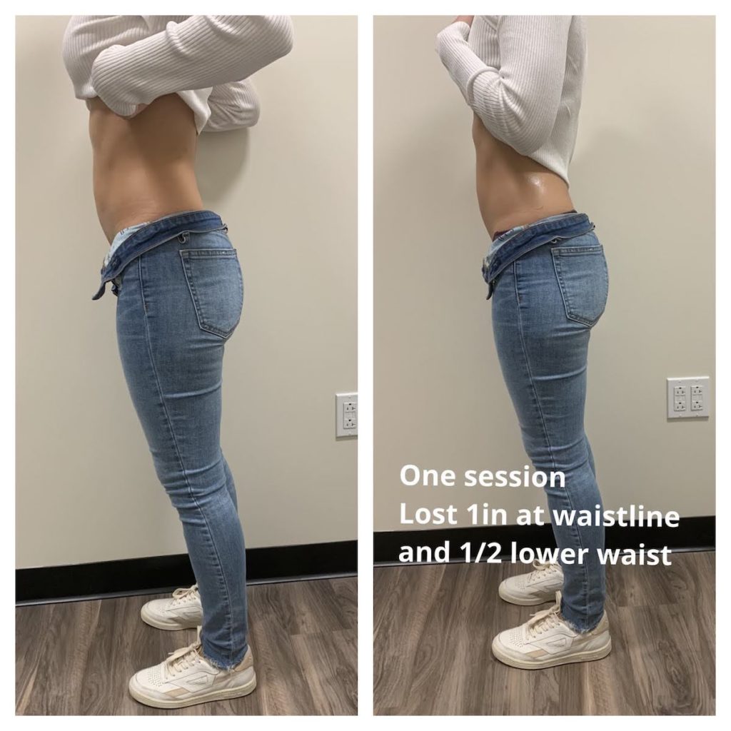 before and after results Chicago body contouring TushToners