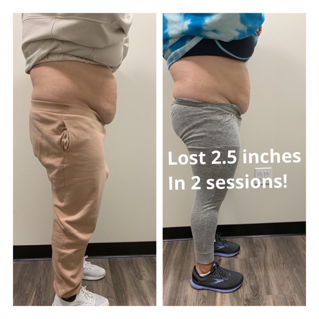 weight loss Chicago body contouring before and after