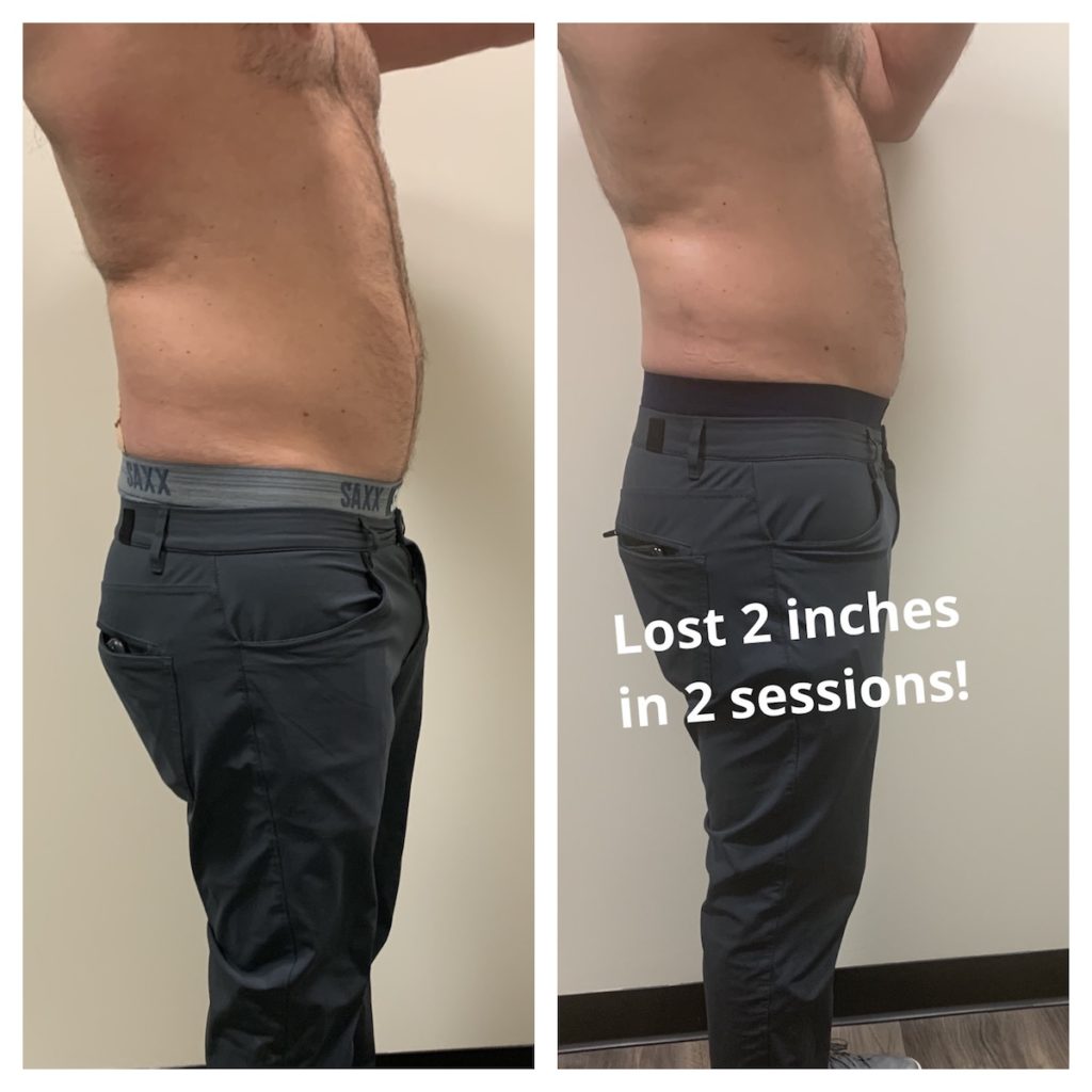 before after results Chicago body contouring TushToners