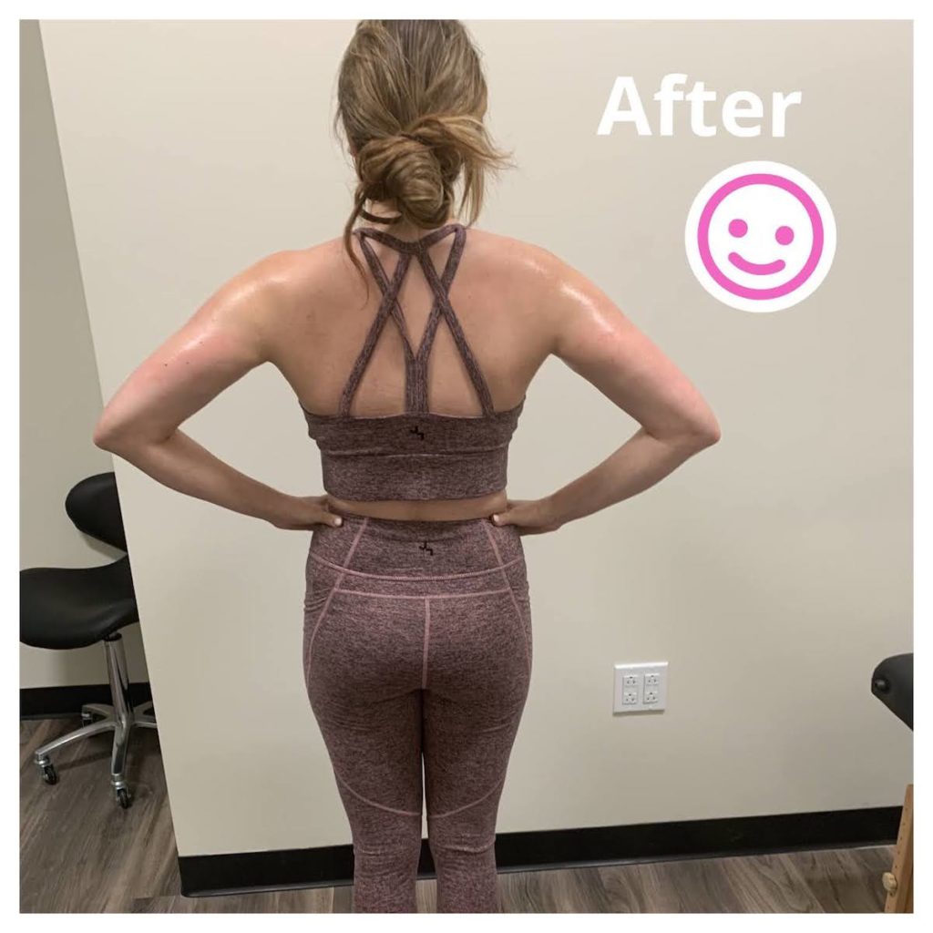 TushToners before and after Chicago body contouring