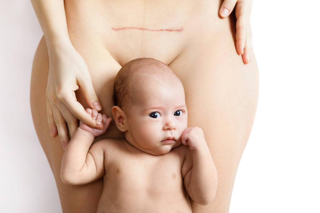 body contouring post c-section