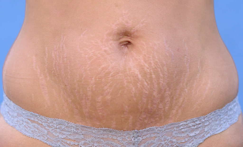body contouring post baby