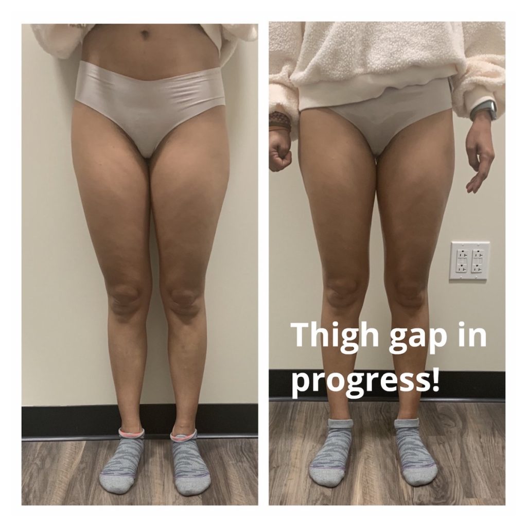 thigh gap Chicago body contouring