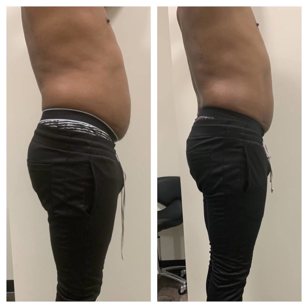 Male body contouring Chicago