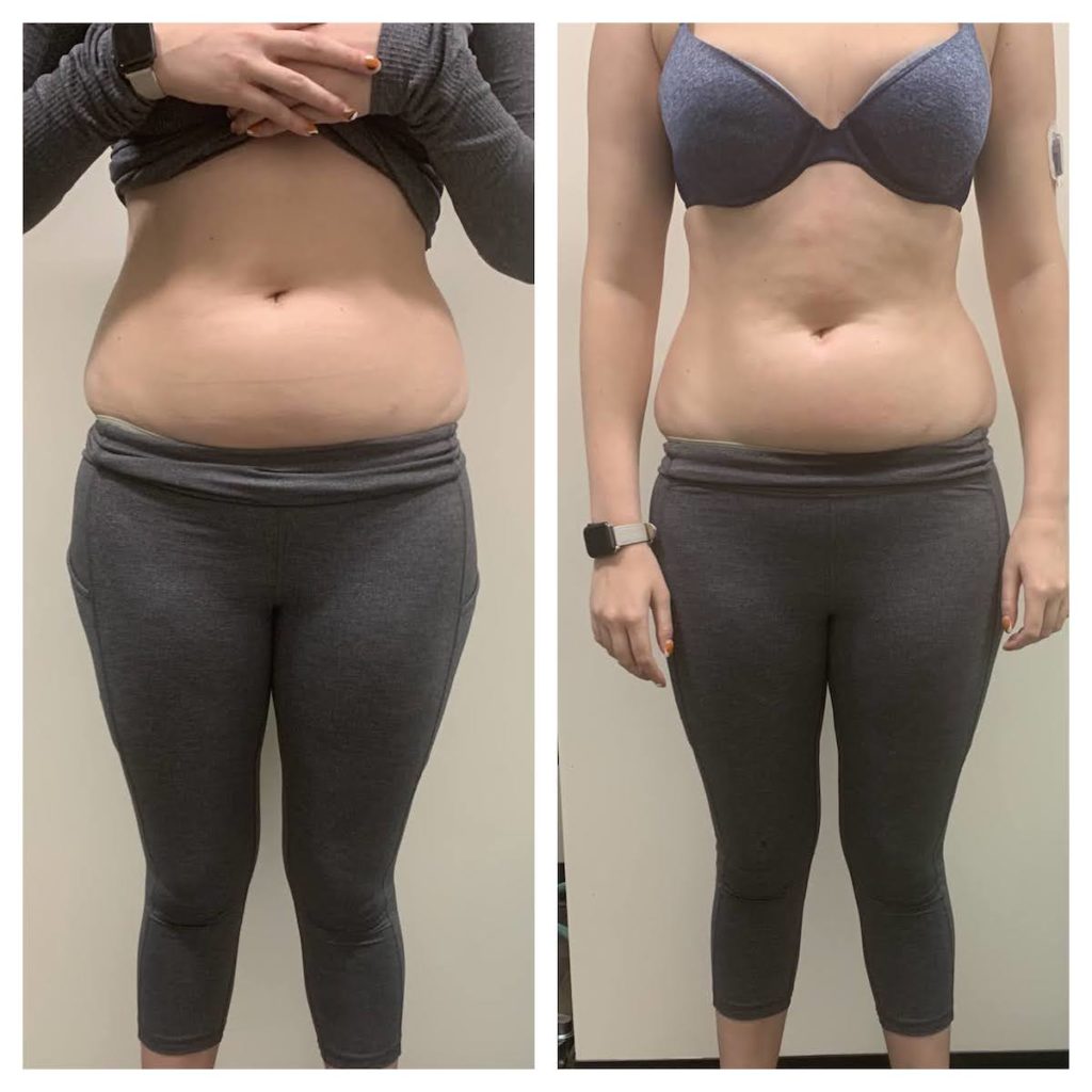 before and after body contouring Chicago