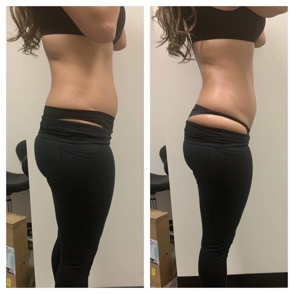 body contouring Chicago before after