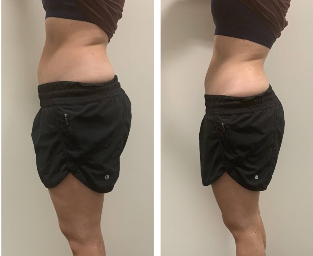 body contouring before and after chicago TushToners