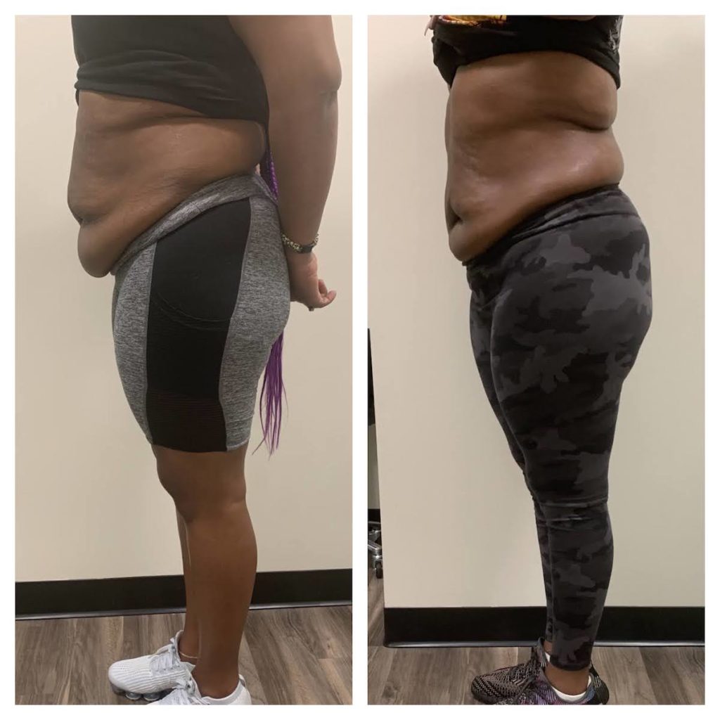 body sculpting Chicago before after stomach