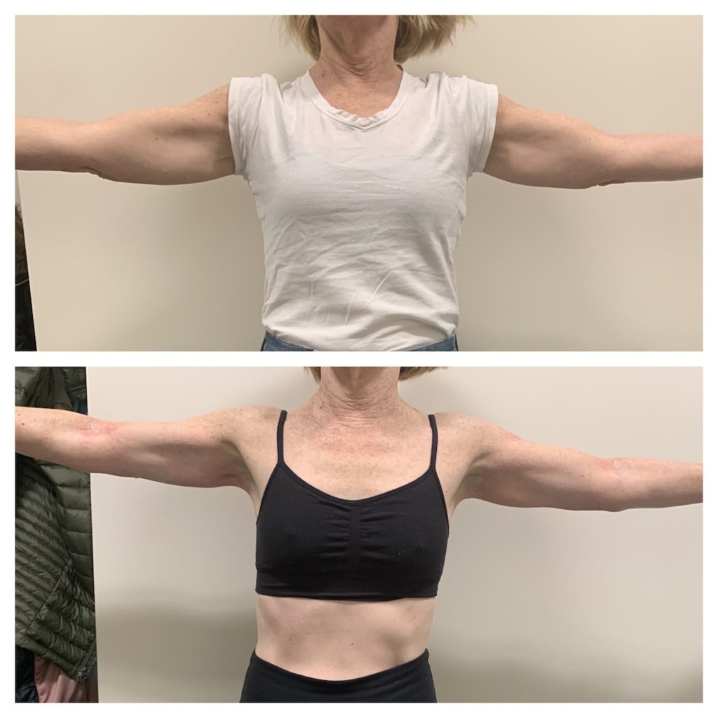 body contouring chicago before and after