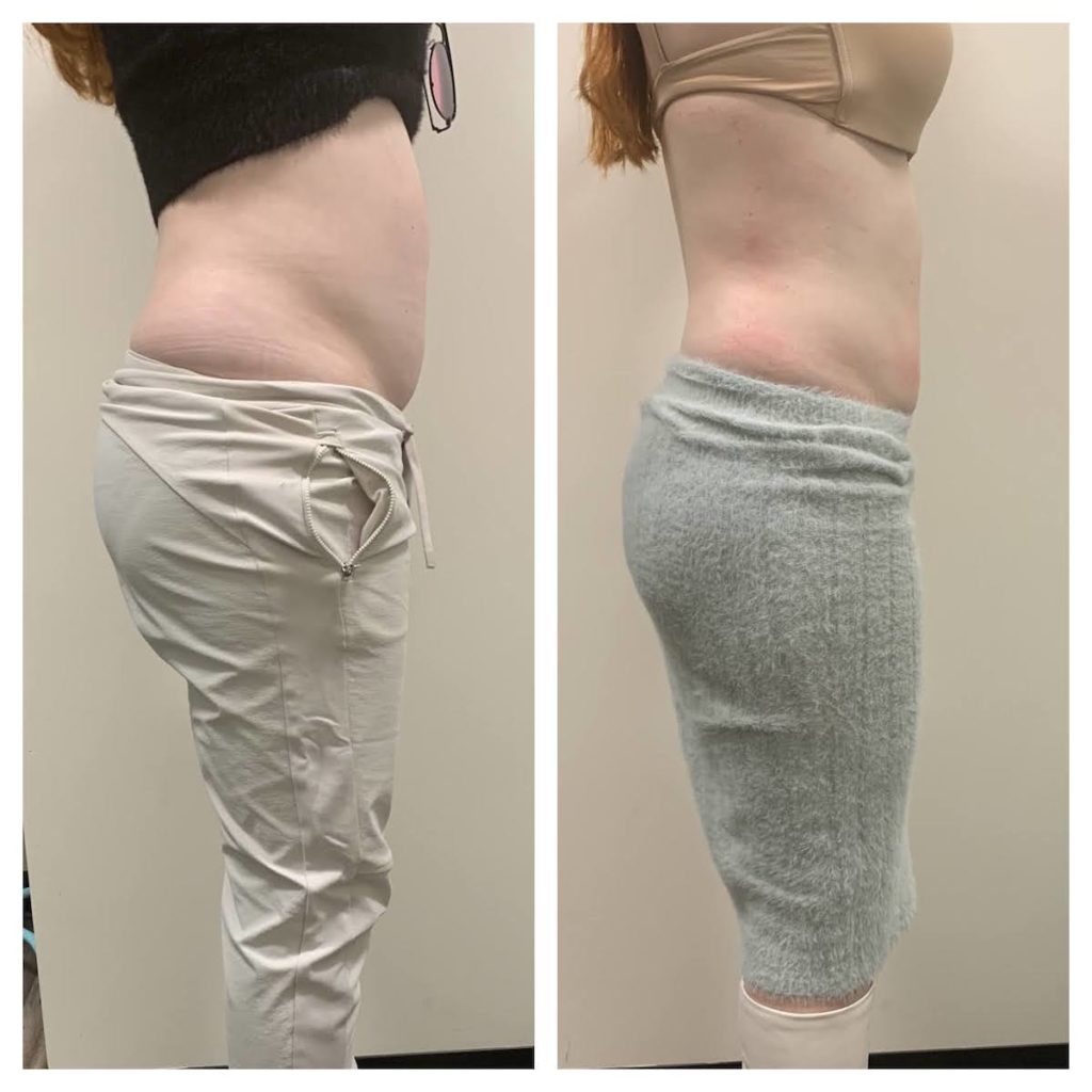 Noninvasive body contouring chicago before and after pics