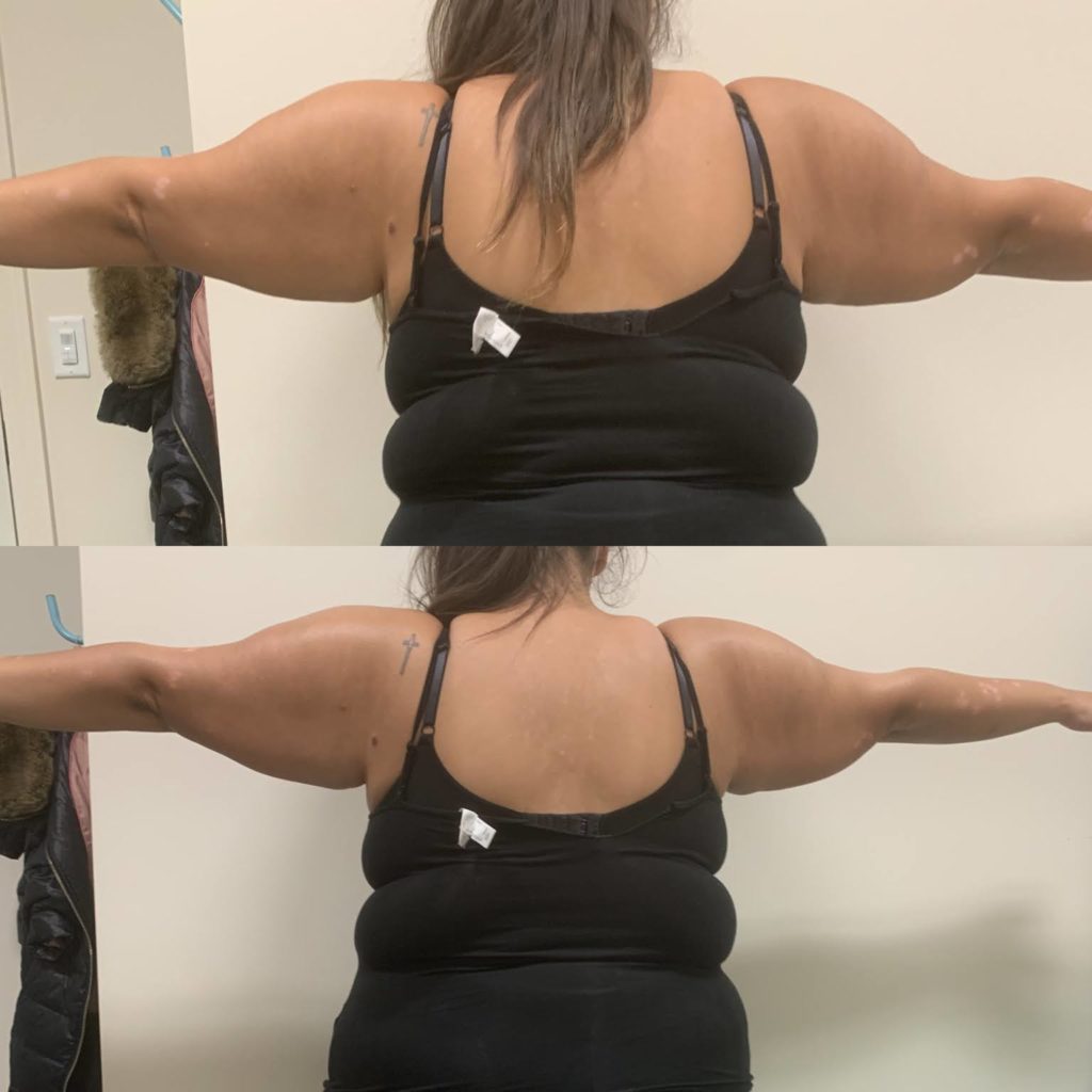 reduce arm fat chicago body contouring before and after