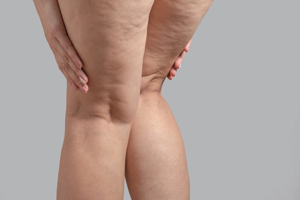 radiofrequency cellulite treatment Chicago